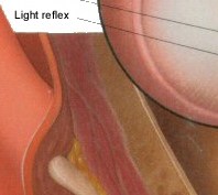 Right Tympanic Membrane